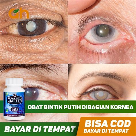 Obat Bintik Putih Di Bagian Kornea Penglihatan Terasa Terganggu