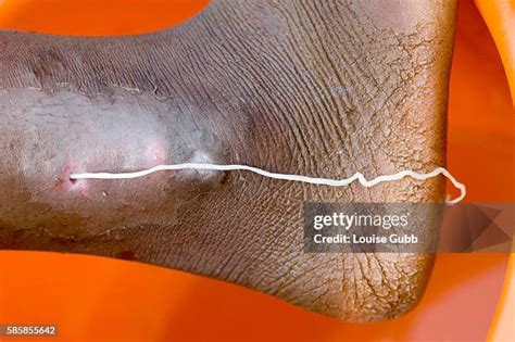 110 Guinea Worm Stock Photos, High-Res Pictures, and Images - Getty Images