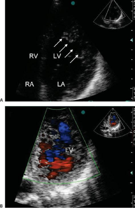 A Apical 4 Chamber Echocardiogram And B Parasternal Short Axis View Download Scientific