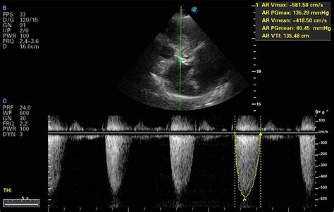 Continuous Wave Doppler Of The Aortic Valve Showed Severe Aortic