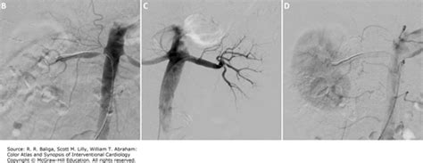 Renal Artery Stenosis Color Atlas And Synopsis Of Interventional