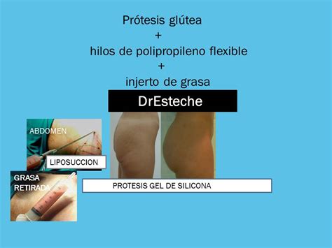 Dr Esteche Cirugía Plástica de Glúteos Buttocks surgery GLUTEAL