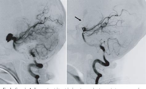 Figure From Three Cases Of Thrombosed Giant Aneurysms Of Posterior