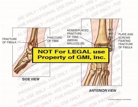 Pre Op Vs Post Op Conditions 96140a4b Generic Medical Legal Exhibits A Division Of Mvi