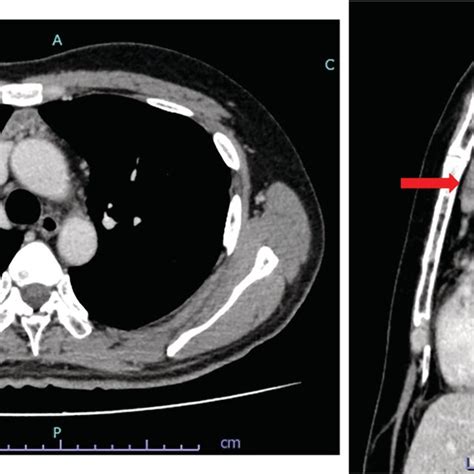 Contrast‐enhanced Computed Tomography Revealed A 4 0 × 2 5 Cm Mass In