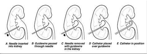 Percutaneous Nephrostomy Drainage Treatments Patients And Families