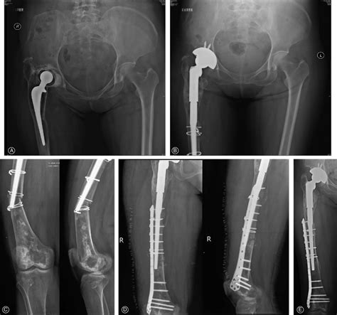 A Preoperative Anteroposterior Ap Radiograph Of The Right Hip In A