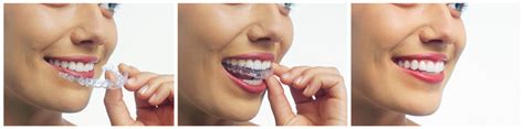 Does Invisalign Really Work As Well As Traditional Braces