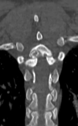 Osteoid Osteoma Spine Image Radiopaedia Org