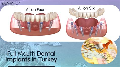 Full Mouth Dental Implants Turkey Package Deals Dentafly