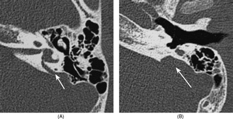 Imaging And Clinical Findings In Large Endolymphatic Duct And Sac