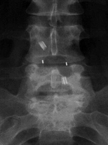 Lumbar Spine Fusion And Stabilization Hardware Techniques And