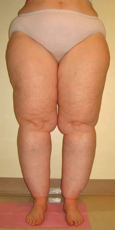 Everything You Need To Know About Lipedema Lipoedema Lymphedema