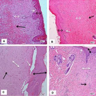 Photomicrographs showing epidermal hyperplasia (black double-head ...