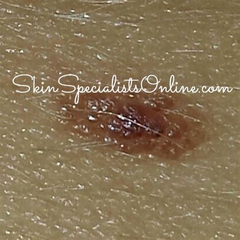 Ask A Skin Doctor: Atypical Mole - Skin Specialists Online