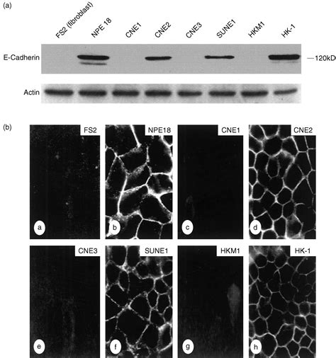 The Association Of E Cadherin Expression And The Methylation Status Of