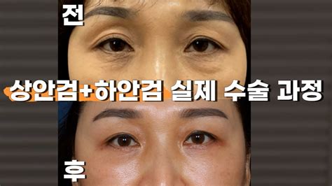 사진으로 보는 상안검 하안검 수술 전후 과정 연세미도 성형외과 YouTube