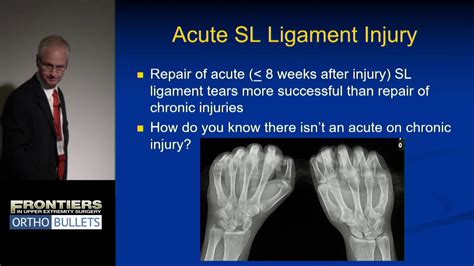 Scapholunate Repair Michael S Bednar Md Frontiers In Upper