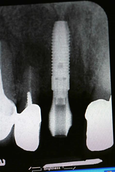 5 Axis Dental Design Center Scanning Jig For Itero Bone Level Implant