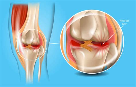 Meniscal Tears Repair Vs Resection Lmcg Orthopaedics