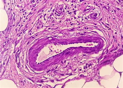 Photomicrograph Of Granulomatous Tissue Histology Stock Image Image