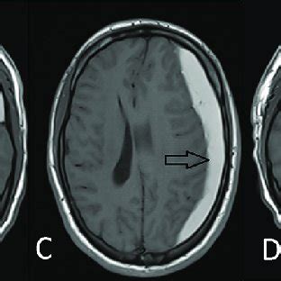 Axial T1W MRI A B T2W C MRI Coronal MRI D And Sagittal MRI E