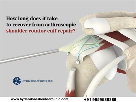 How long does it take to recover from arthroscopic shoulder rotator ...