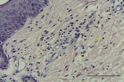 Glucagonoma Syndrome With Atypical Necrolytic Migratory Erythema