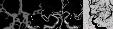 Frontiers Use Of PETRA MRA To Assess Intracranial Arterial Stenosis