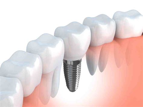 En Qu Consiste La Colocaci N De Implantes Con F Rula Quir Rgica