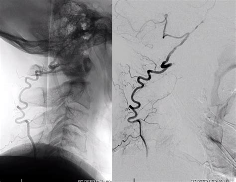 Deep Cervical Artery