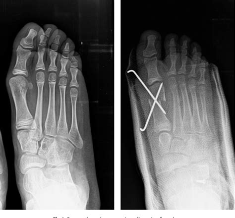 Figure From Surgical Correction Of Hallux Valgus Deformity In