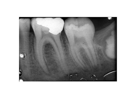 Apikale Parodontitis Definitionen Odontium Zahnschmelz Dentin Pulpa Apikale