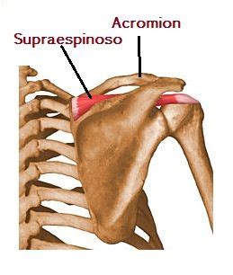 Lesi N De Hombro Tendinitis Del Supraespinoso Qu Es Causas 16182 The