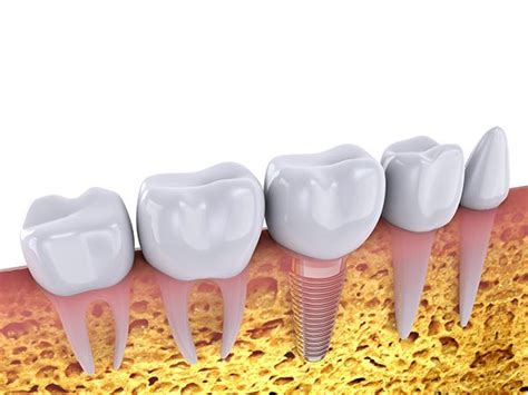 9 Things You Should Know About Dental Implants Dentarana