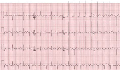 read  paediatric ecg resus