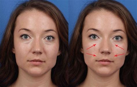 Overview Of Juvederm Under Eyes Swelling Hannah Toby