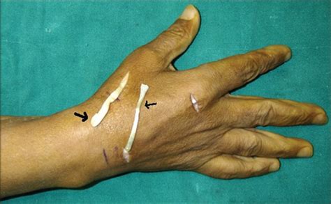 Late Extensor Pollicis Longus Rupture Following Plate Fixation In