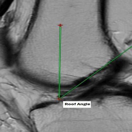 Sagittal T W Image Showing The Intercondylar Roof Angle Formed Between