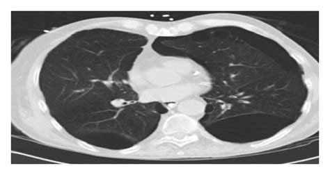 Chest Ct Coronal View Showing Bilateral Lung Bullae More Than One Third