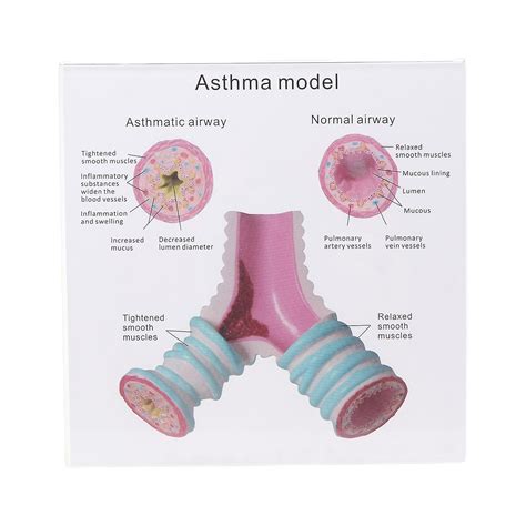 Bronchus Trachea Anatomical Model With Display Stand For Aasthma