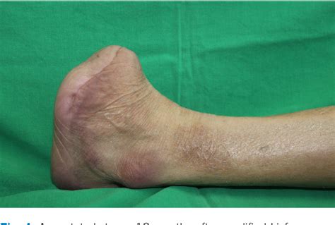 Figure 4 From Modified Lisfranc Amputation To Reduce Hematoma Rate In Diabetic Foot Ulcer