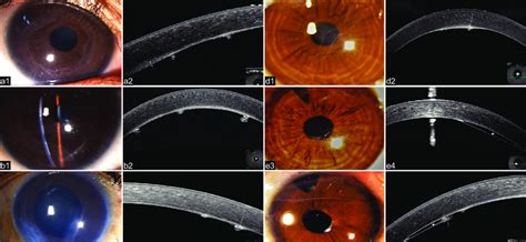 Older Treated Pcg Diffuse Illumination Slit Lamp Biomicroscopy Of The