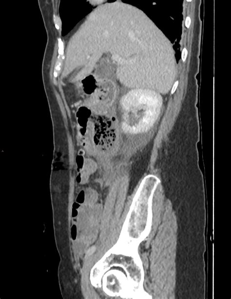 Duodenal Diverticulitis Image