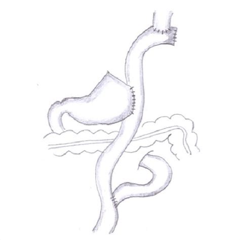 Roux-en-Y esophago-jejunostomy after laparoscopic total gastrectomy ...