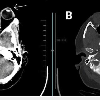 CT brain scan of the patient shows the proptosis of the left eye. (A)... | Download Scientific ...