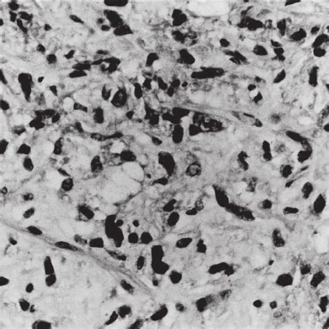 Hematoxylin And Eosin Stained Bone Marrow Biopsy Showing Dispersed