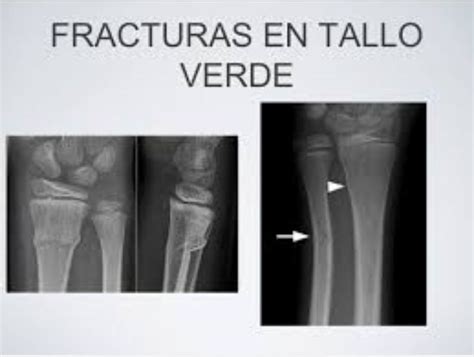 Fractura En Tallo Verde Fracturas Verde Taller