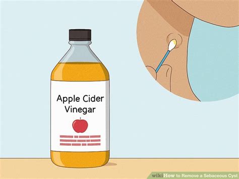 how to remove sebaceous cyst at home
