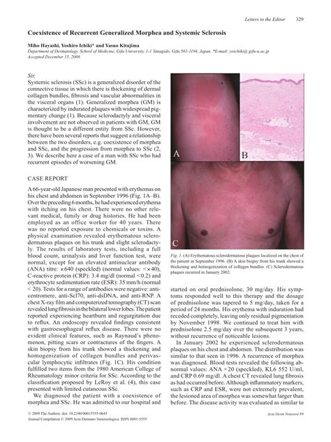 Pdf Coexistence Of Recurrent Generalized Morphea And Systemic Sclerosis